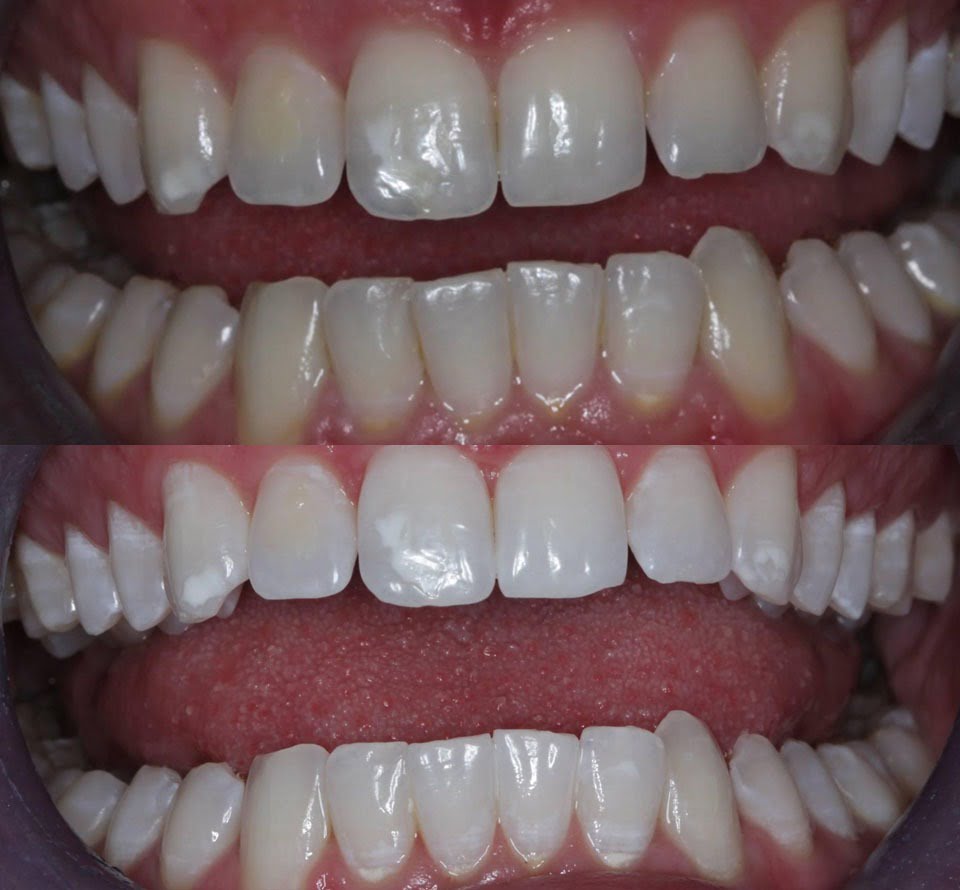 dental before and after